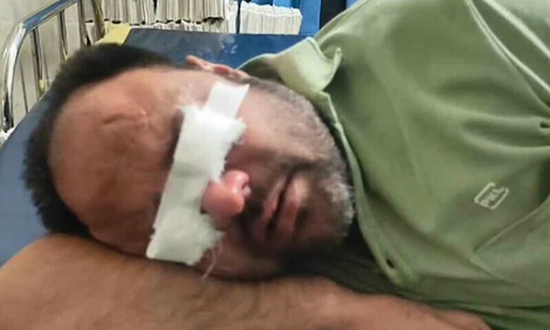 گنج پن سے بچنے کے لیے تیل استعمال کرنے والے200 افراد امراض چشم کا شکار - World